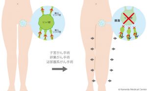 リンパ浮腫の原因の図解-脚 images of the cause of edema-legs