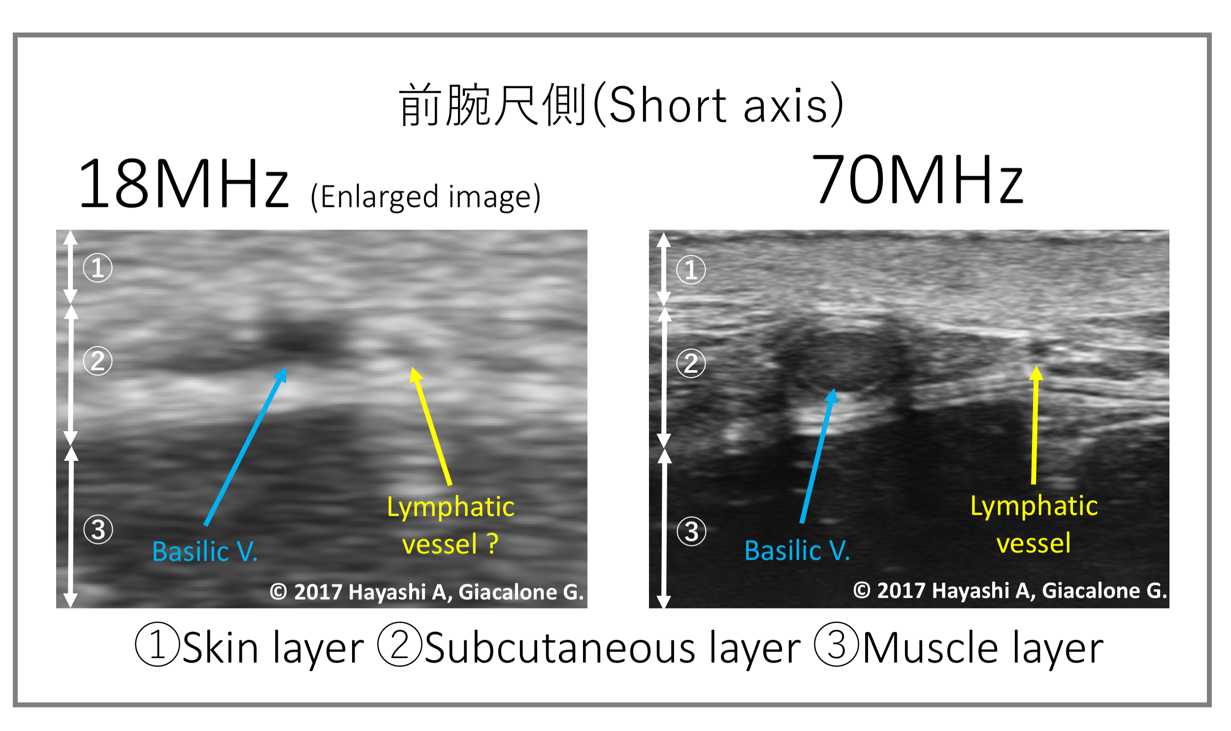 最新の画像診断 : 前腕尺側（Short axis）